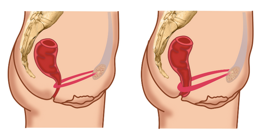 Constipation and your Pelvic Floor