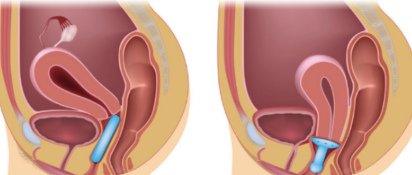 Prolapse can be the cause of your constipation